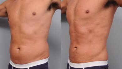 liposuction-options-and-costs:-what-you-need-to-know